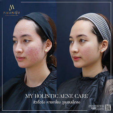 acne.jpeg