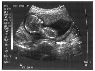 An Ultrasound of My Literary Baby