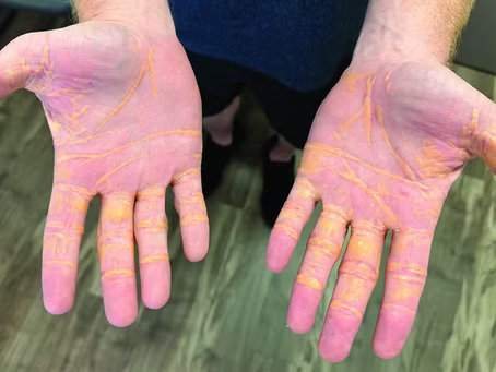 Xantelasma: o que é a condição que fez homem 'vazar' colesterol pelas mãos após dieta rica em gordura