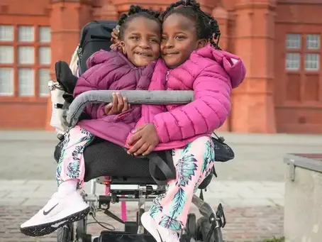 As gêmeas siamesas que estão sobrevivendo contra todas as expectativas