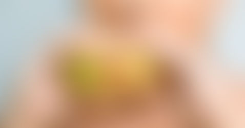 Pela primeira vez, número de crianças com obesidade supera o de jovens com desnutrição