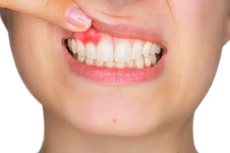 Nenhuma doença é mais comum na América Latina e no Caribe do que cárie, gengivite e perda de dentes