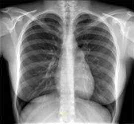 Ultrassom vs. raio-X: diagnóstico de tuberculose pulmonar em crianças