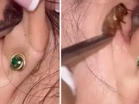 Médica tira barata do ouvido de paciente e viraliza; saiba o que fazer em situação semelhante