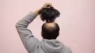 Golpe capilar: médico com CRM cassado promete cabelo a carecas