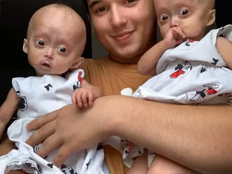 Raríssimo: conheça as gêmeas brasileiras com síndrome de Benjamin Button