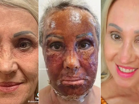 Procedimento estético faz mulher 'trocar de rosto' e mudança viraliza