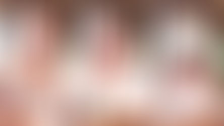 Alopecia areata: doença que fez mãe de Lucas Lucco perder cabelo tem tratamento de alto custo e afeta a saúde mental