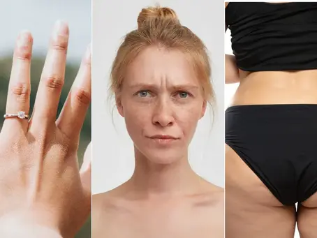 Anatomia Ozempic: dedo, rosto e bumbum: os efeitos não desejados do emagrecimento com o remédio