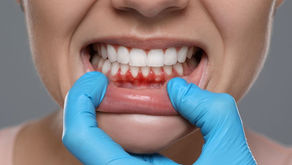 O que cárie e gengivite têm a ver com AVC? Estudo indica aumento significativo no risco de derrame