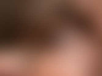 Implante de córnea artificial recupera visão de homem de 91 anos