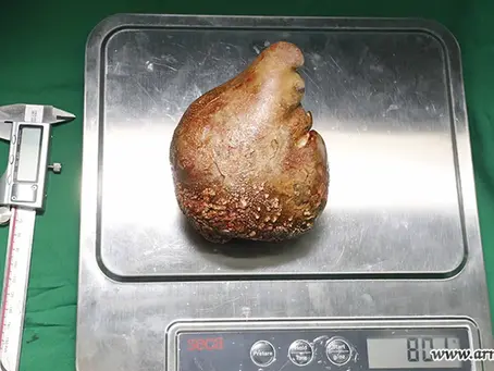 Médicos retiram de paciente a maior e mais pesada pedra no rim do mundo