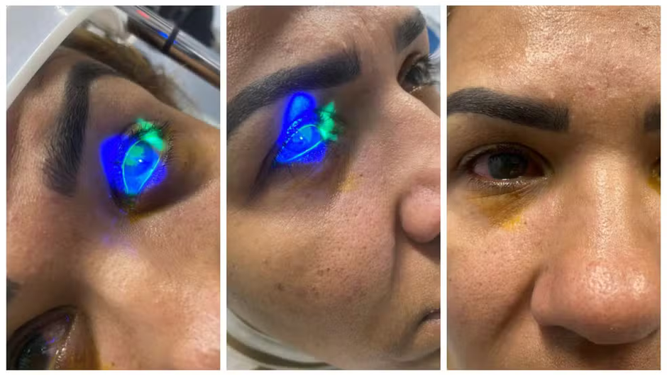 Queimadura nos olhos após uso de sérum para cílios: internautas relatam reações e médicos fazem alerta