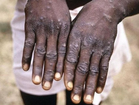 Varíola dos macacos: doença contagiosa rara gera alerta em 27 Estados nos EUA