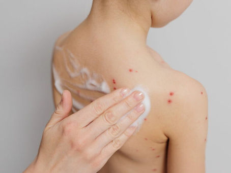 Pela primeira vez em dez anos, criança morre infectada em surto de sarampo nos Estados Unidos