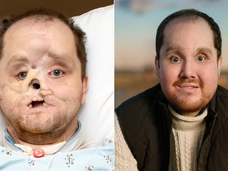 Homem recebe transplante de rosto inovador: ‘segunda chance’; veja imagens