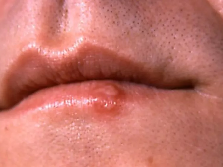 Pesquisa liga beijos na Idade do Bronze a origem da herpes labial
