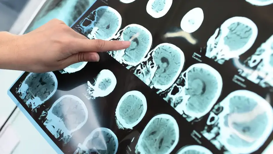 Novo teste pode identificar tipo de tumor cerebral em menos de duas horas e acelerar diagnóstico