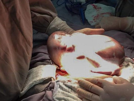 Bebê nasce dentro da bolsa amniótica durante parto raríssimo