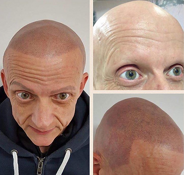 Male Scalp Tattoo For Alopecia