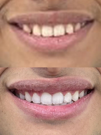 Invisalign Barra da Tijuca