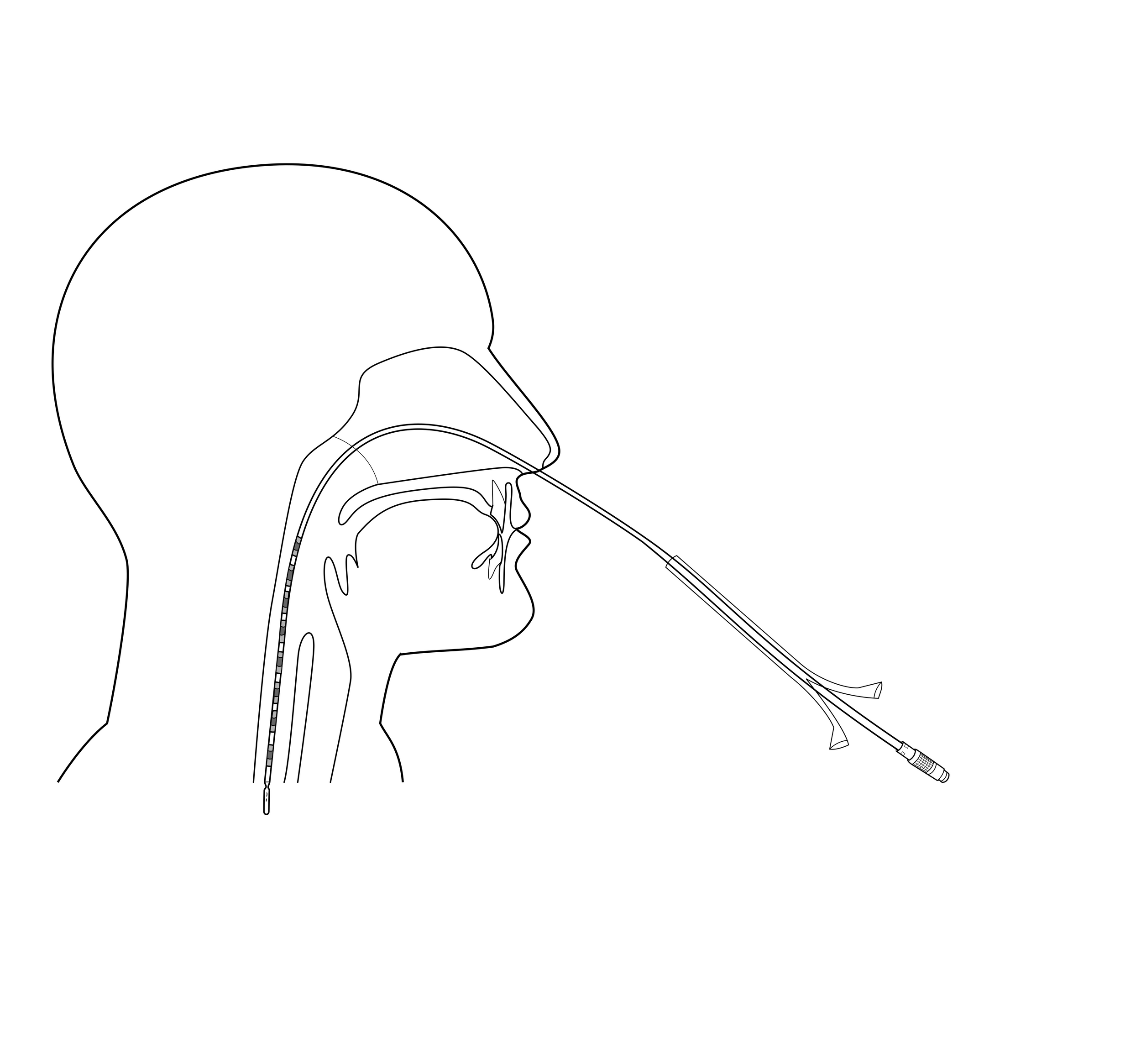 SLP ENT Reflux Testing pH Monitoring Medical