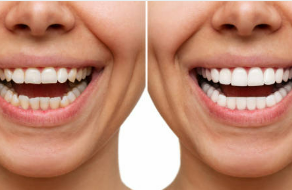 Before and after smile design