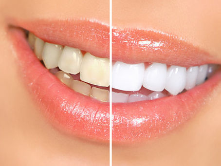 Before and After Split Screen of Teeth Whitening