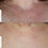 Thumbnail: Before and after, Renu 28, cellular skincare, facial rejuvenation, antiageing, skincare