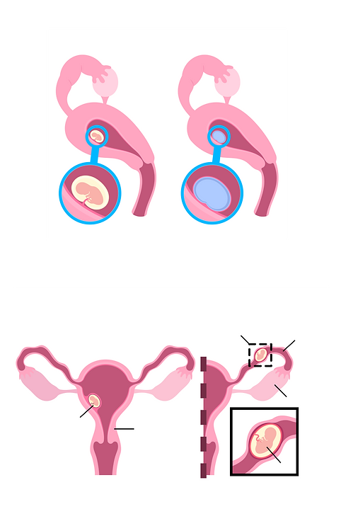 abnormal pregnancies 2.png