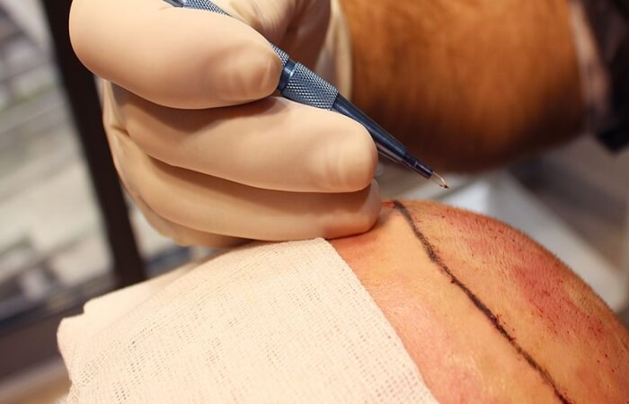 قلم السفير لزراعة الشعر