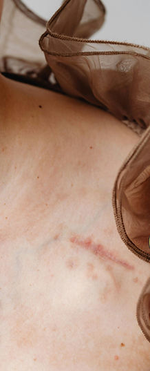 Before and after photo of someone who has been treated for scar rejuvenation