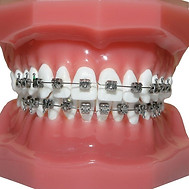 metal-braces.jpg