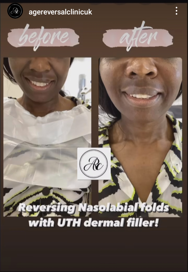 Nasolabia Treatment with dermal filler
