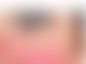 Rosacea: A Closer Look