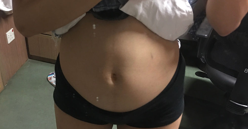 severe bloating after binging