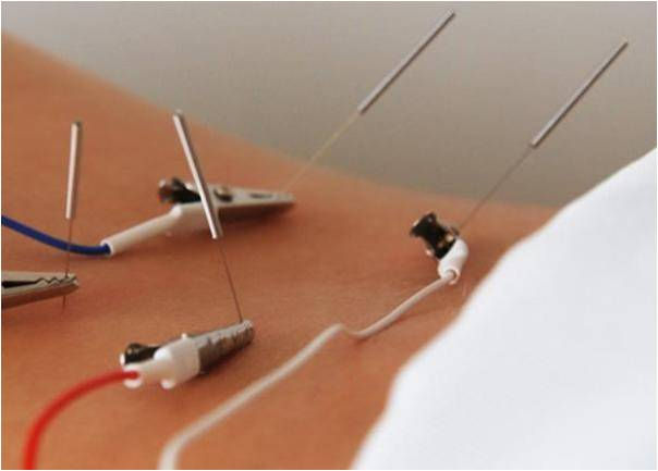 Electrical Stimulation