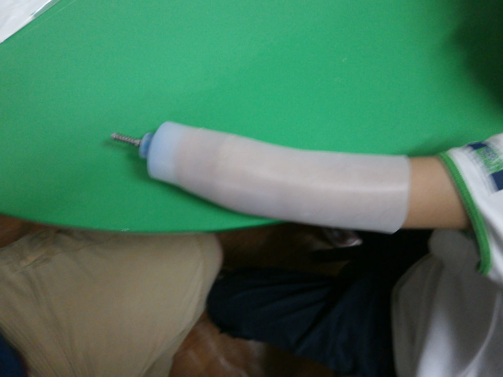 Below Elbow - Liner & Pin 2