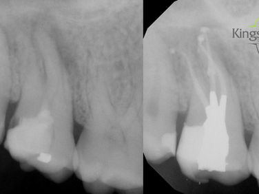 Root Canal Treatment: What is it all about?