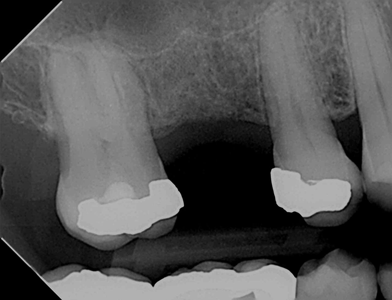The x-ray of this missing tooth shows insufficient bone for an implant due to a low sinus floor