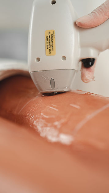 Depilacja laserowa_chromatica_theskin.jpg