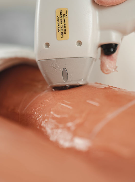 Depilacja laserowa_chromatica_theskin.jpg