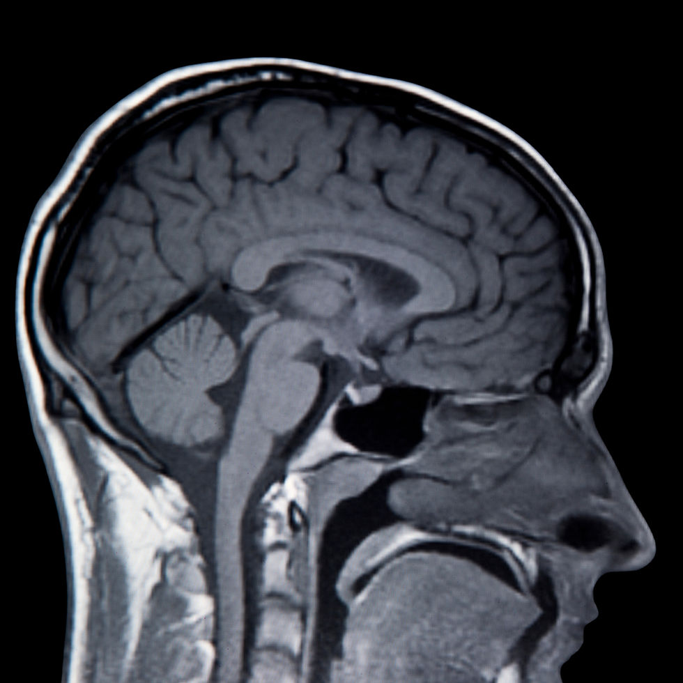 Concussion pics (1200 x 1200 px)_edited.jpg