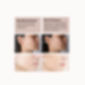 Before Microdermabrasion (Instagram Post) (1).png