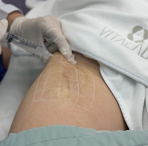 pbserum Enzyme Scar Treatment_thumbnail.jpg