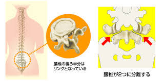 分離症.jpeg