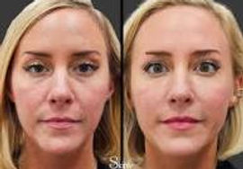 cheek filler.jpg