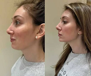 Jawline filler final.jpg