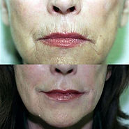 Water bottle botox.jpg