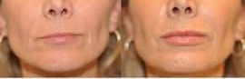 lip filler.jpg